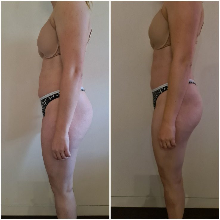 Voorbeeldresultaat BodySculpting PRO 1: voor en na