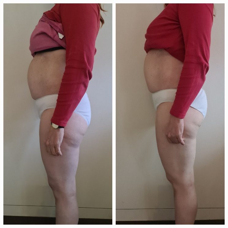 Voorbeeldresultaat BodySculpting PRO 2: voor en na