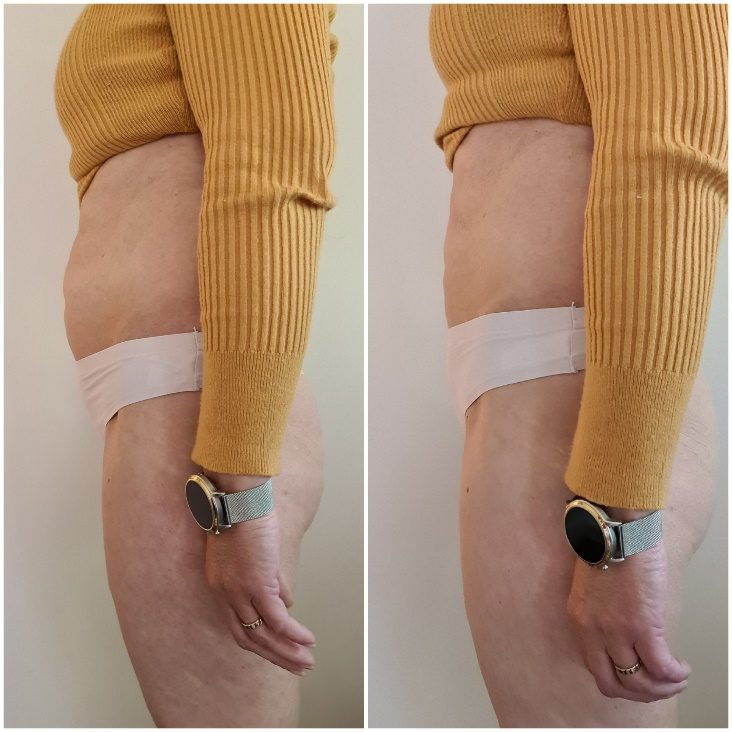 Voorbeeldresultaat BodySculpting PRO 3: voor en na