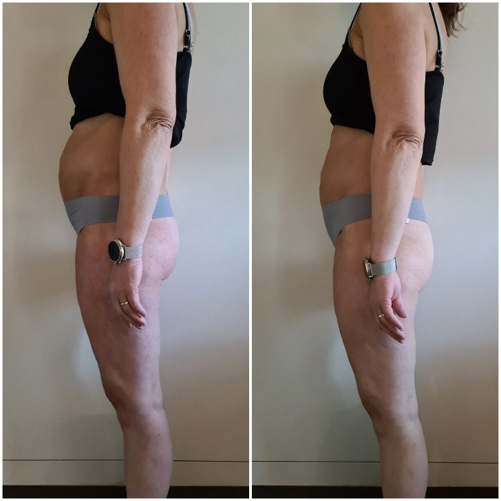 Voorbeeldresultaat BodySculpting PRO 4: voor en na
