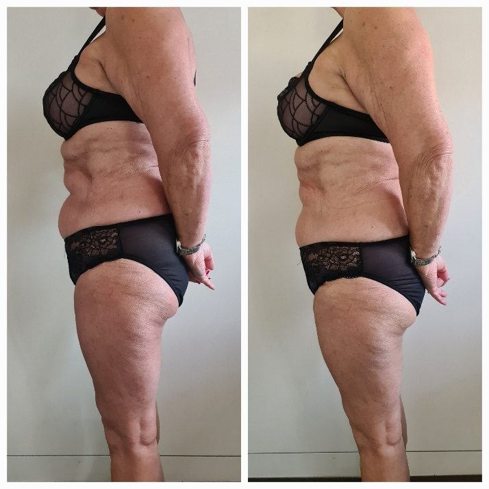 Voorbeeldresultaat BodySculpting PRO 9: voor en na