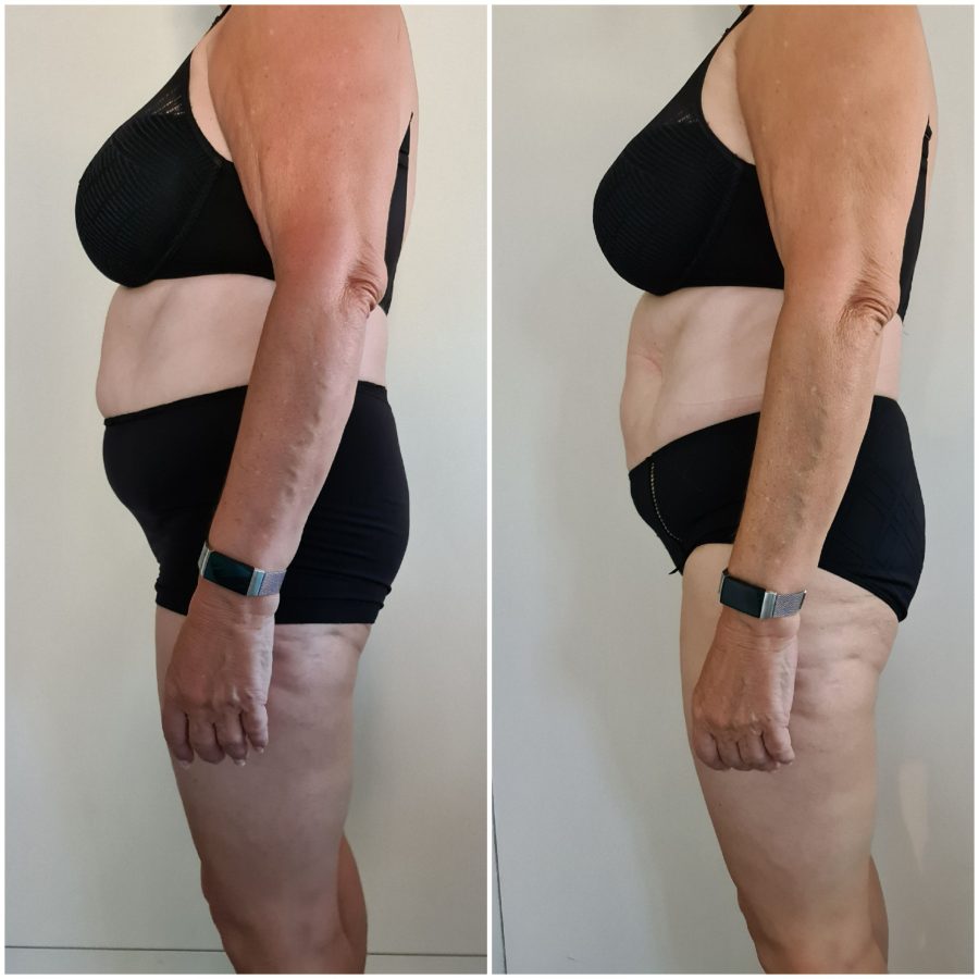 Voorbeeldresultaat BodySculpting PRO 11: voor en na
