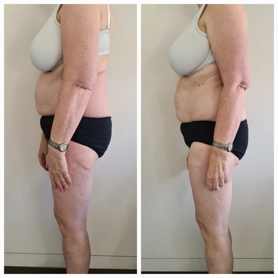 Voorbeeldresultaat BodySculpting PRO 12: voor en na